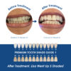 Whiter Image - Whitening - Gingival Barrier - 06