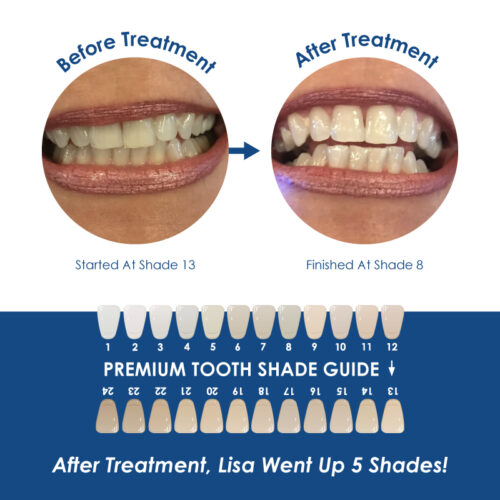 Whiter Image - Whitening - Gingival Barrier - 06