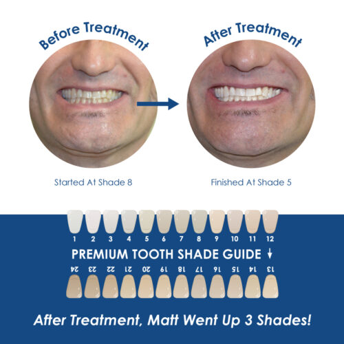 Whiter Image - Whitening - Prefilled Tray Kit - 07