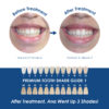 Whiter Image - Whitening - Mouth Tray with Case - 07
