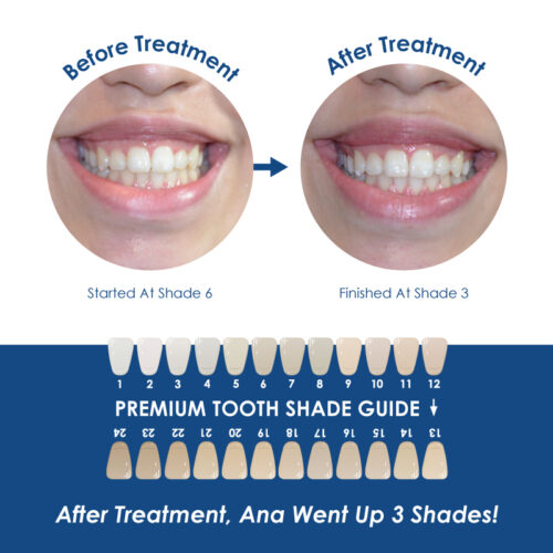 Whiter Image - Whitening - Mouth Tray with Case - 07