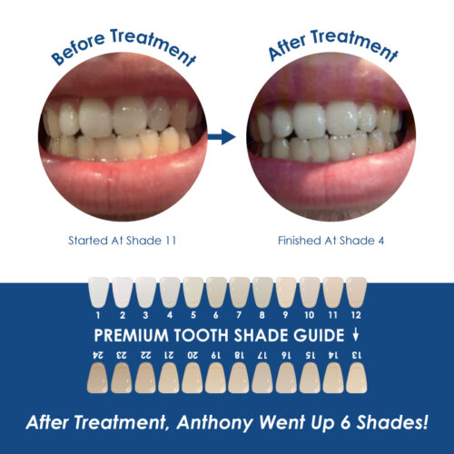 Whiter Image - Whitening - In-Office 40% HP 2 Patient Whitening Kit - 05