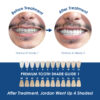 Whiter Image - Whitening - Deluxe Home Whitening System - 07