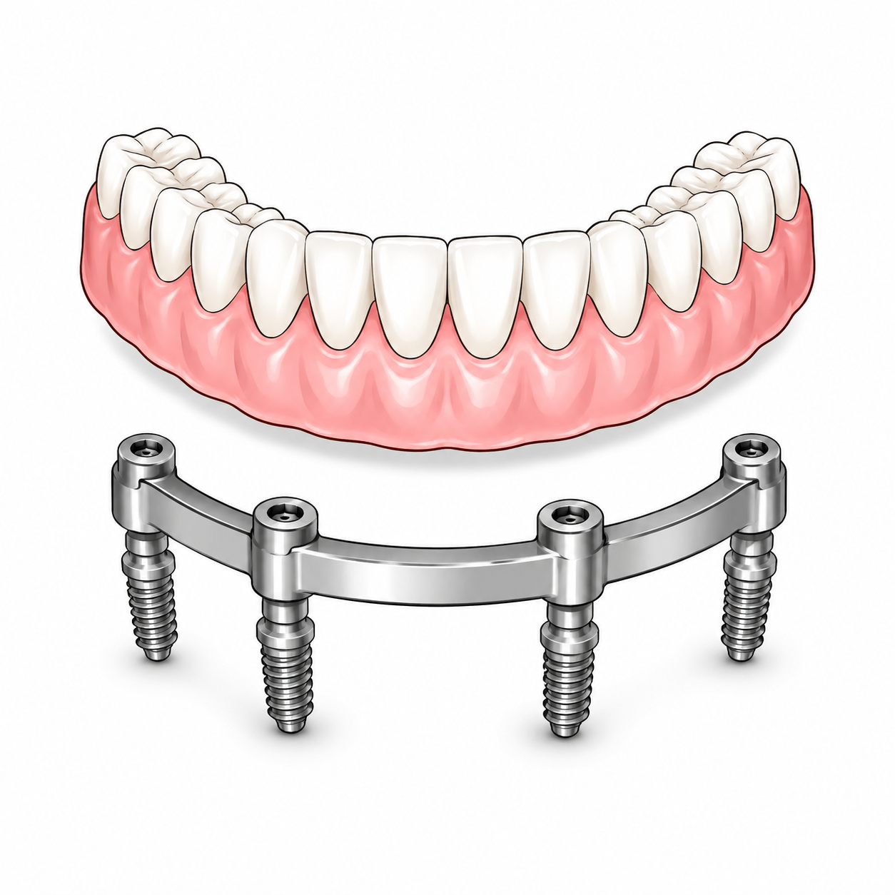 All-on-X and bar design