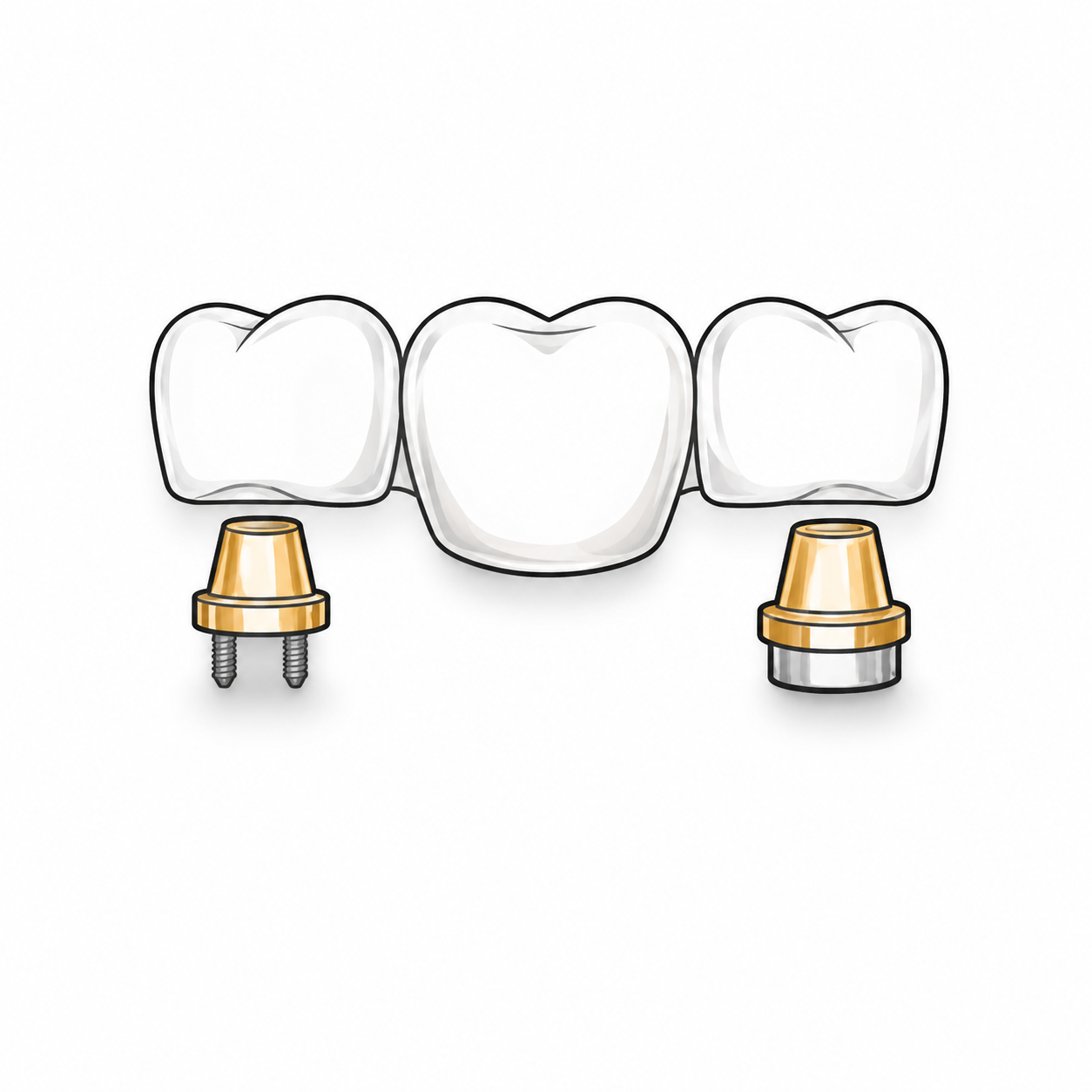 Crown and bridge design