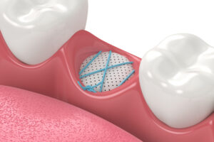 “Is Bone Grafting Still Necessary for Dental Implants?” with Dr. Rick Ferguson