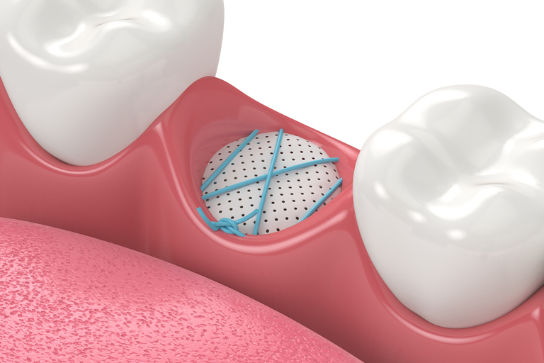 Medidenta - Blog - Is Bone Grafting Still Necessary for Dental Implants with Dr. Rick Ferguson - 01