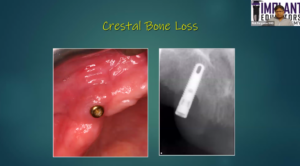 Is Bone Grafting Still Necessary for Dental Implants with Dr. Rick Ferguson