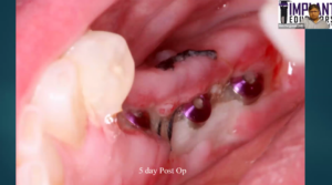 Is Bone Grafting Still Necessary for Dental Implants with Dr. Rick Ferguson