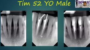 Is Bone Grafting Still Necessary for Dental Implants with Dr. Rick Ferguson